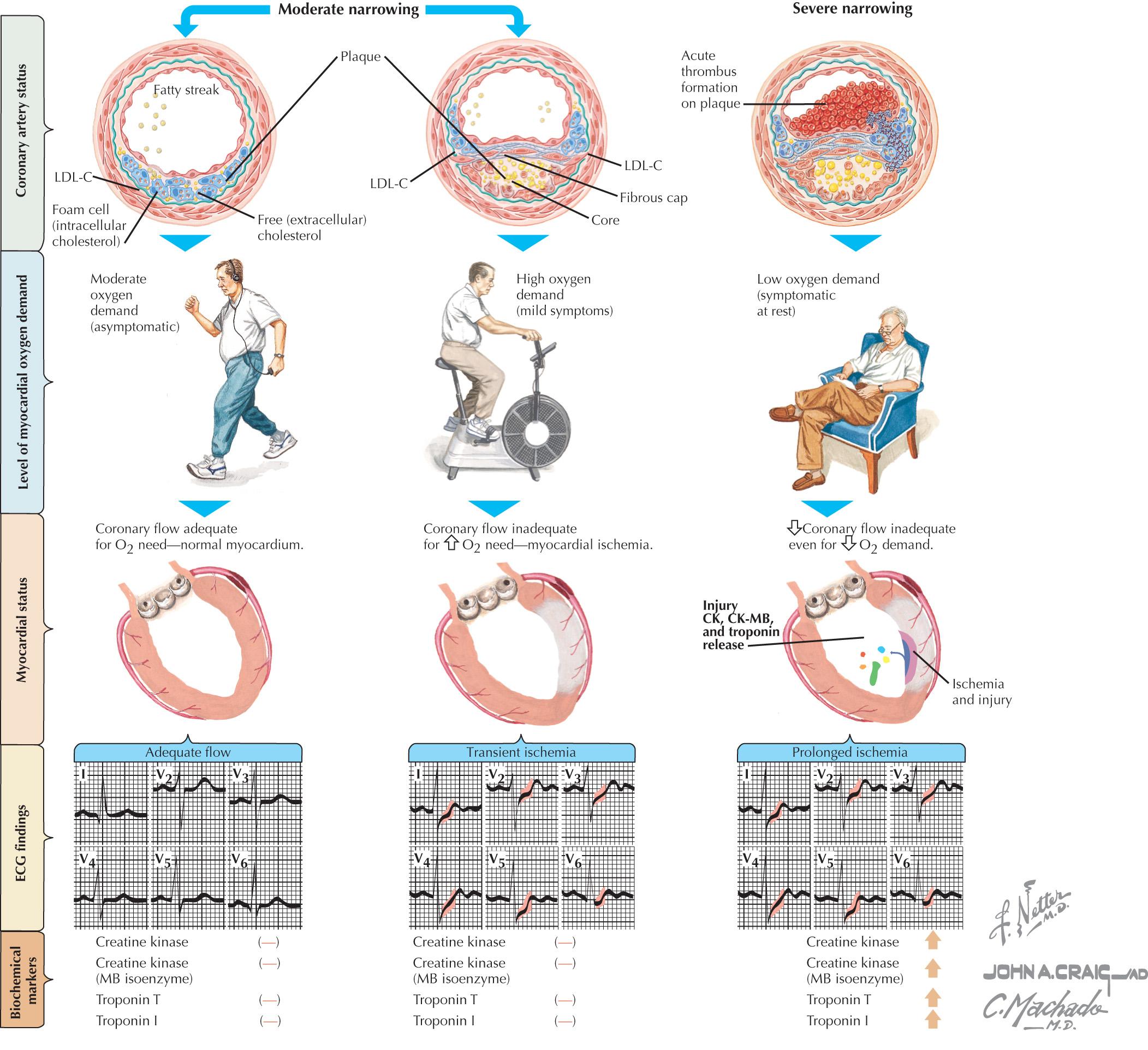 FIG 20.2, Risk Stratification for Patients With Coronary Heart Disease.