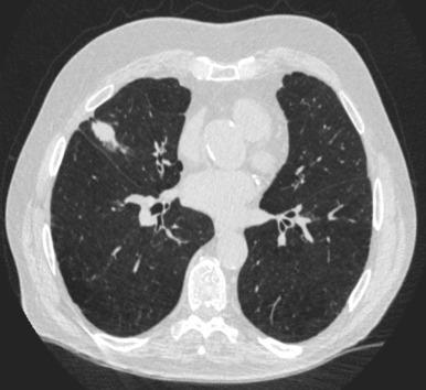 Fig. 51.1, Computed tomography scan of a 78-year-old man with a screen detected cT1c N0 non–small cell lung cancer.