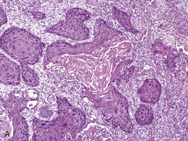 Fig. 51.2, Hematoxylin and eosin photomicrographs of a squamous cell carcinoma demonstrating keratin pearl formation (A) and adenocarcinoma with papillary features (B).
