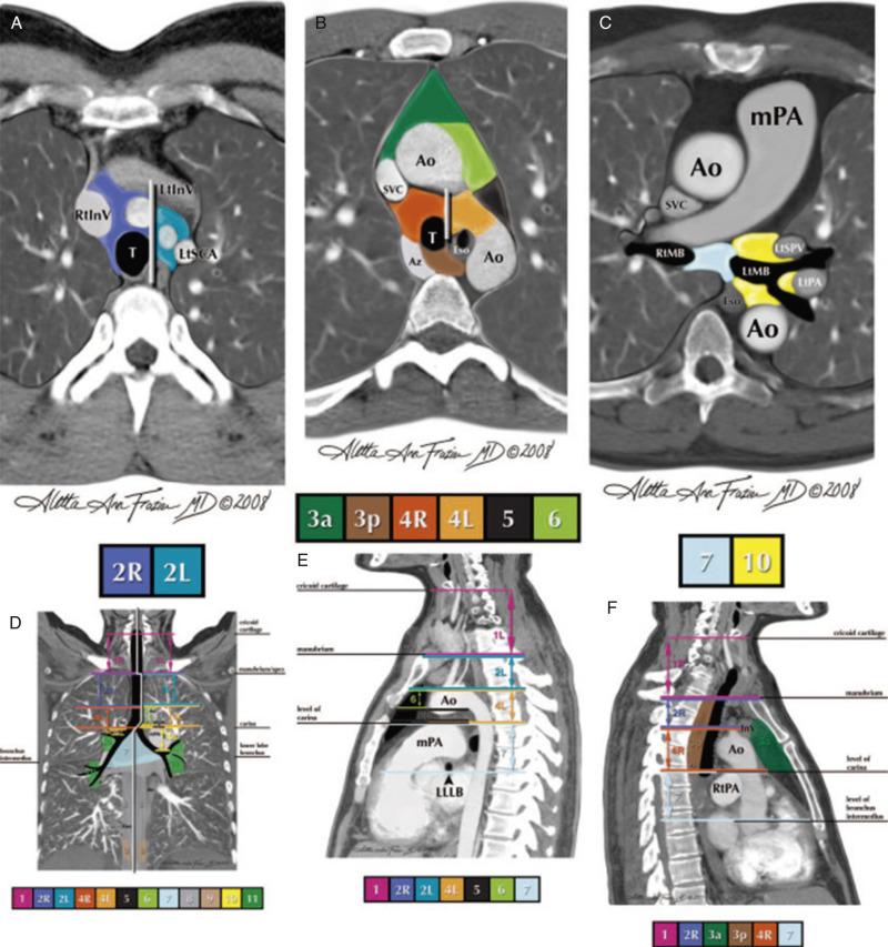 Fig. 51.3, Illustrations of how the International Association for the Study of Lung Cancer (IASLC) lymph node map can be applied to clinical staging by computed tomography scan in axial (A-C), coronal (D) and sagittal (E, F) views. The border between the right and left paratracheal region is shown in (A) and (B). Ao, Aorta; AV, azygous vein; Br, bronchus; IA, innominate artery; IV, innominate vein; LA, ligamentum arteriosum; LIV, left innominate vein; LSA, left subclavian artery; PA, pulmonary artery; PV, pulmonary vein; RIV, right innominate vein; SVC, superior vena cava.