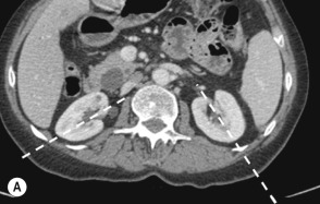 Fig. 85.1, Computed Tomography Images of the Renal Axis and Disposition.