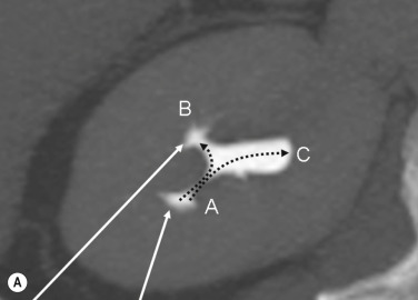 Fig. 85.2, Calyceal Selection for Renal Access.