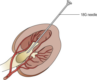 Fig. 85.5, Safest Place to Puncture a Calyx.