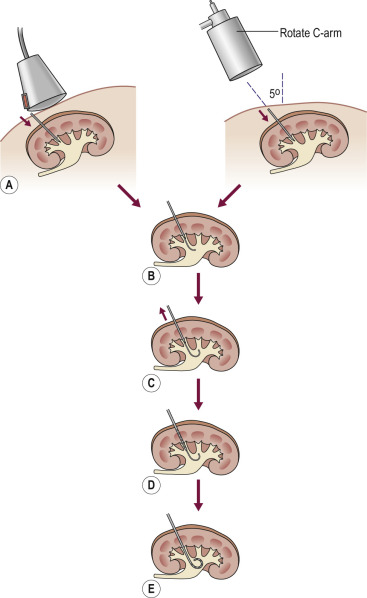 Fig. 85.6, Single Puncture Percutaneous Nephrostomy.