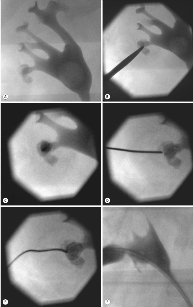 Fig. 85.7, Fluoroscopically Guided Single Puncture for Percutaneous Nephrolithotomy Access.