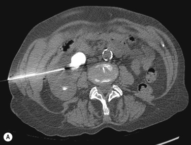 Fig. 85.8, Computed Tomography-Guided Nephrostomy.