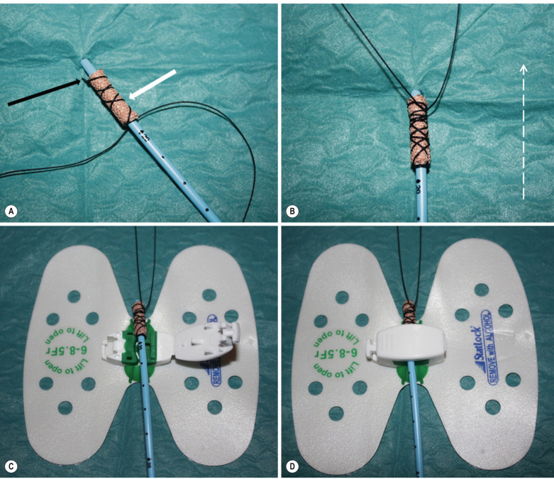 Fig. 85.9, Securing a Nephrostomy Catheter.