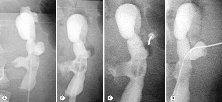 Fig. 85.10, Fluoroscopically Guided Percutaneous Nephrostomy of a Horseshoe Kidney.