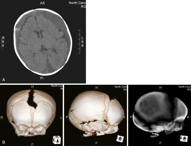 Fig. 20.1, (A) Axial computed tomographic (CT) scan of the skull. (B) Reformatted images. The findings and anatomic relationships are not adequately characterized with the use of the axial images alone. In this case, supplemental three-dimensional/multiplanar reformatted images were generated, clearly identifying the left frontal and right parietal skull fractures existing with the mixed-density subdural hematomas, bulging fontanelle, and widened sutures noted on the axial CT.