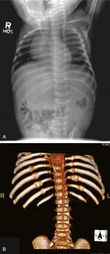 Fig. 20.2, (A) Plain radiograph of ribs, in which fractures are difficult to diagnose. (B) Computed tomographic scan after volume rendering with a TeraRecon Aquarius workstation (San Mateo, CA). This represents a sophisticated platform using a combination of task-specific hardware and software specifically designed to rapidly manipulate large digital imaging and communications in medicine data sets and provide surface-shaded and multiplanar renderings in real time.
