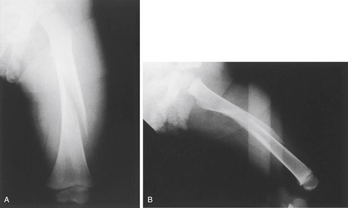 Fig. 20.4, Fracture of the femur in a toddler that occurred as a result of accidental trauma. (A) Anteroposterior radiograph of the femur of a 2-year-old child who tripped while running. This fracture pattern is quite typical of fractures in the toddler age group. Investigation of the family showed no evidence for suspicion, and the child had no other injuries or warning signs of abuse. (B) Lateral radiograph demonstrating the long spiral fracture of the femur.