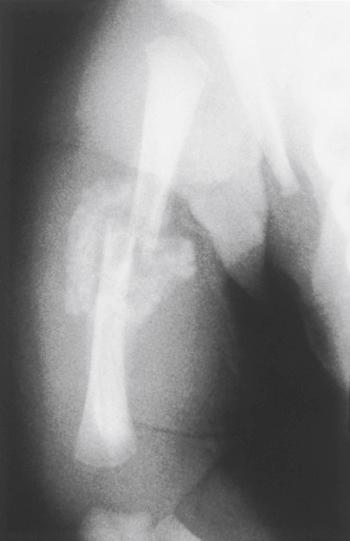 Fig. 20.6, Fracture of the humerus in an infant. An anteroposterior radiograph of the humerus demonstrates a transverse, mid-diaphyseal fracture of the humerus that was the result of child physical abuse. When the child was seen, the fracture was already healing, as demonstrated by the radiograph. The child was found to have other skeletal and soft tissue injuries.