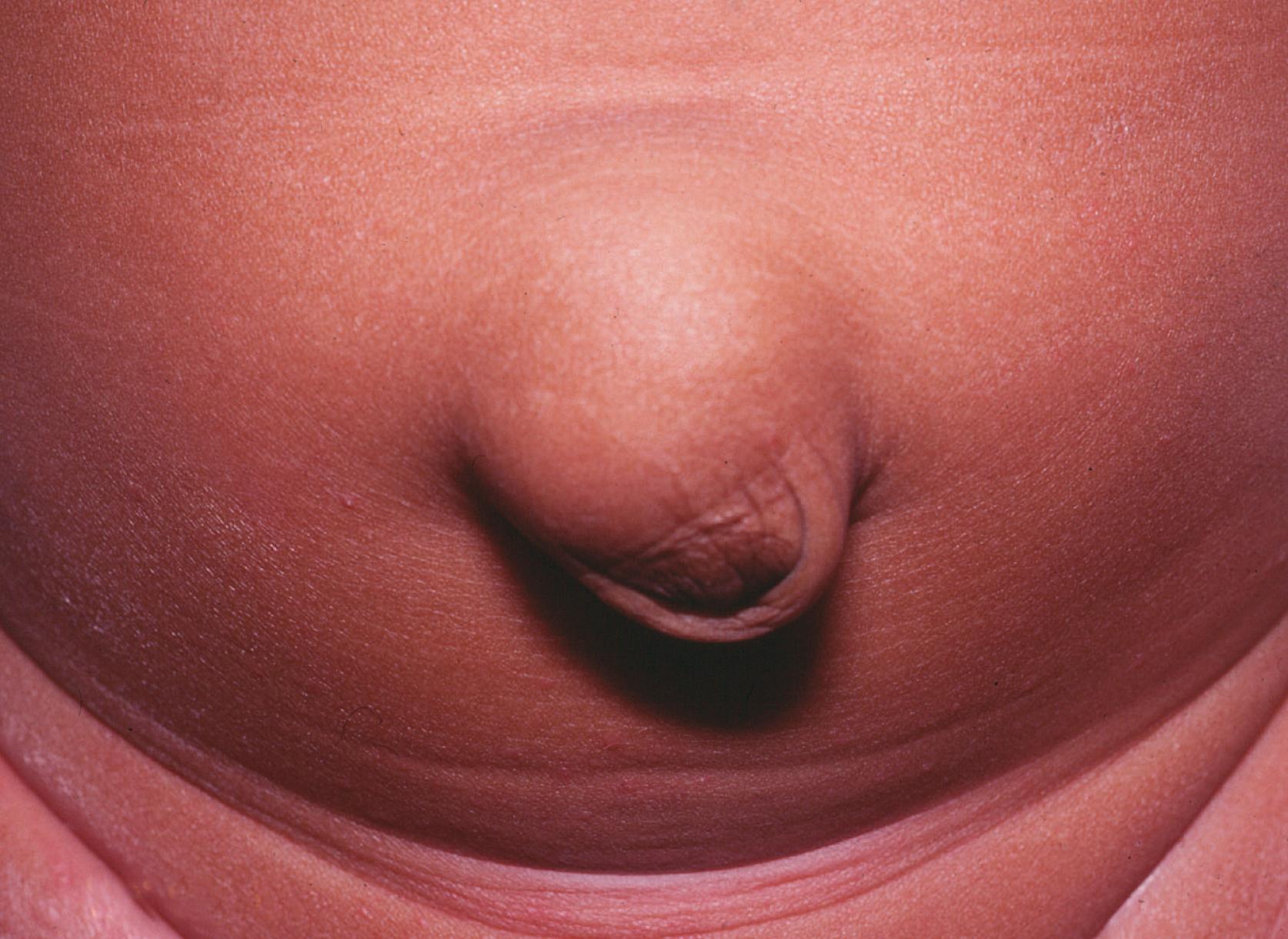 Fig. 51.4, Umbilical Hernia in a 14-Month-Old Boy.