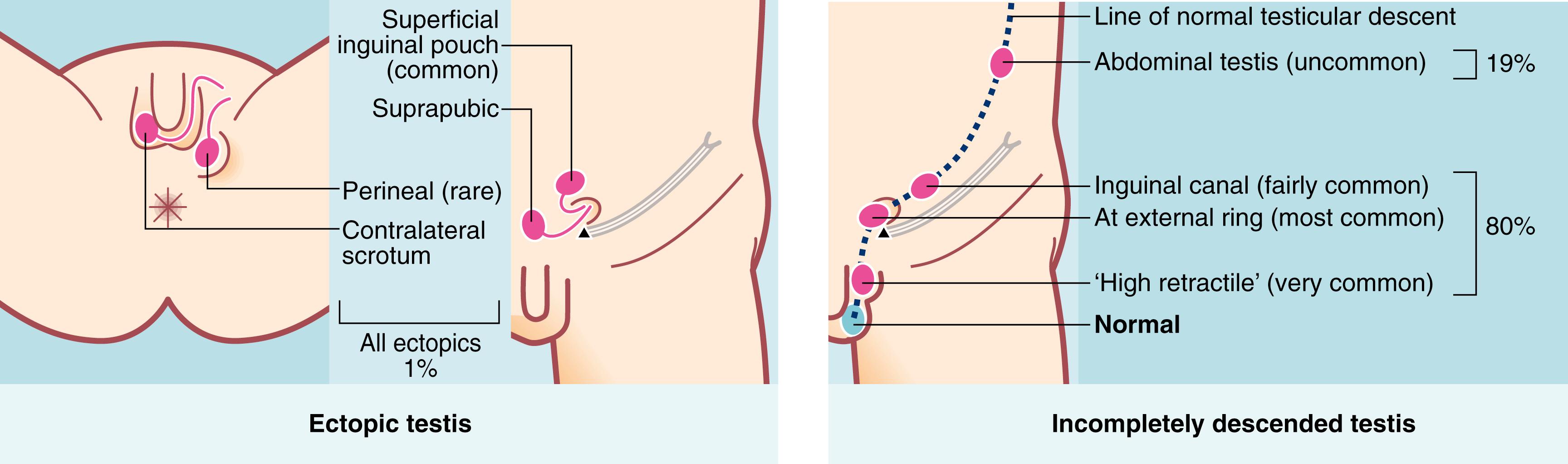 Fig. 51.5, Testicular Maldescent.