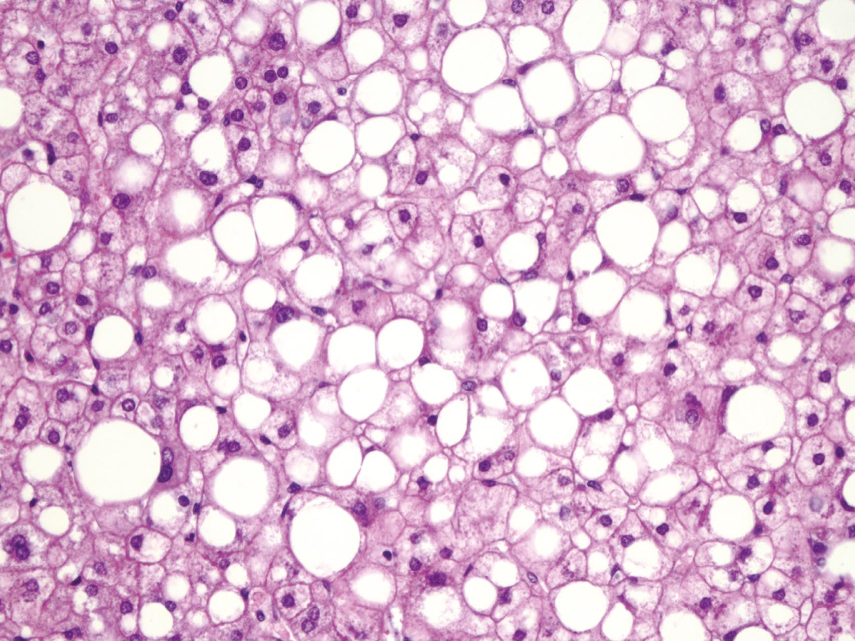 Fig. 87.1, Histologic features of isolated fatty liver. The characteristic feature is diffuse macrovesicular steatosis without significant necroinflammation or fibrosis. Glycogenated nuclei are common (H&E).