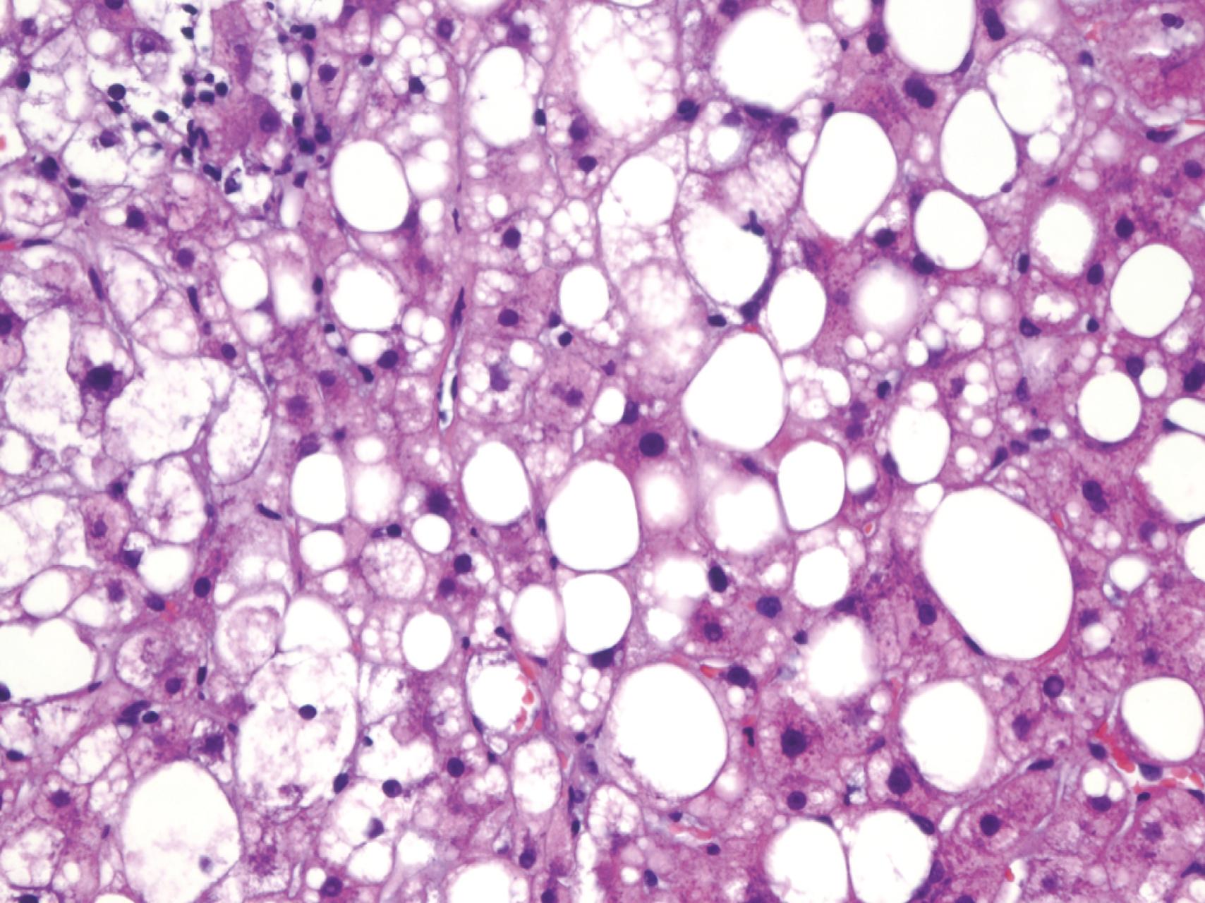 Fig. 87.2, Histologic features of NASH. Diffuse or perivenular macrovesicular steatosis is present. Lobular inflammation consists of neutrophils, lymphocytes, and other mononuclear cells. Hepatocyte ballooning and necrosis of varied degrees are hallmark features. Glycogenated nuclei are present. Mallory bodies, which may be small, sparse, and inconspicuous, are seen (H&E).