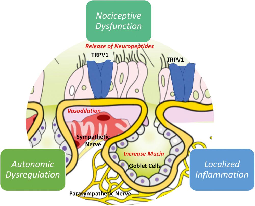 Fig. 39.1, Schematic of suggested mechanisms of nonallergic rhinitis pathophysiology, which include non-IgE–mediated localized inflammation, noninflammatory nociceptive dysfunction through activation of the transient receptor potential cation channel subfamily V receptor 1 (TRPV1) membrane, and autonomic dysregulation of the sympathetic and parasympathetic nervous systems.