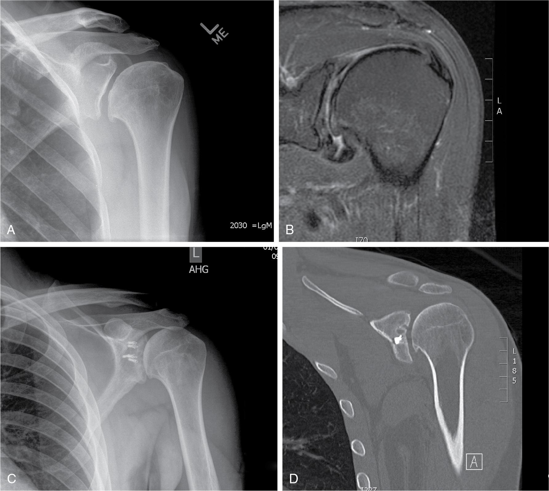 Fig. 41.3, (A) True anteroposterior (AP) Grashey view of a 36-year-old man with early degenerative glenohumeral joint and bipolar cartilage. (B) Coronal magnetic resonance arthrogram of the shoulder shown in (A) better demonstrates the bipolar cartilage and early bony changes. (C) AP view of a shoulder with anchors in the superior quadrant of the glenoid. One of the anchors had eroded through the glenoid and was in contact with the humeral head. (D) Coronal computed tomography scan of the shoulder shown in (C) demonstrating glenoid cystic changes and small humeral head osteophyte.