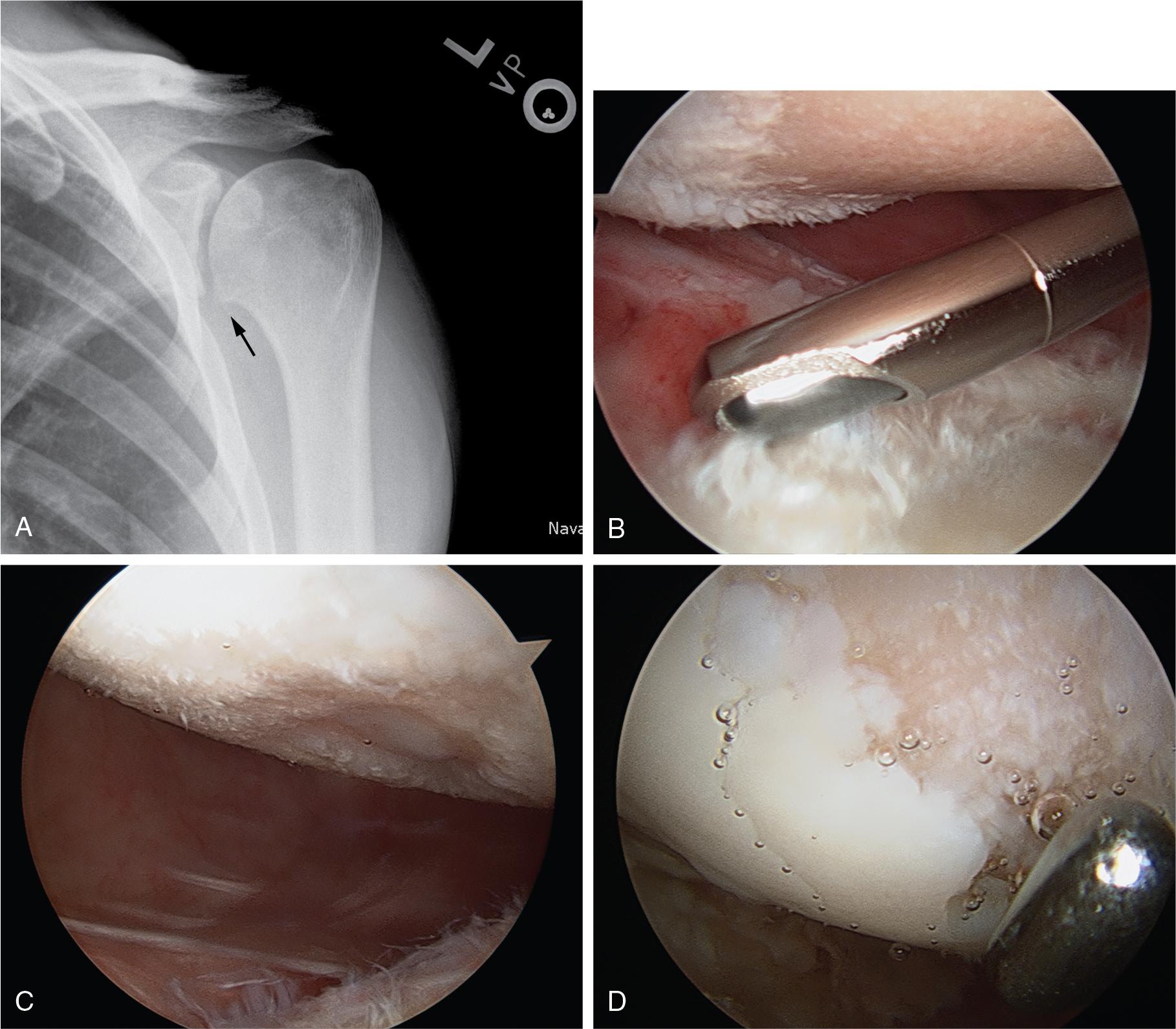 Fig. 41.4, (A) True anteroposterior (AP; Grashey) radiograph of a 27-year-old man 6 months after an arthroscopic Bankart repair with an inert plastic (polyetheretherketone [PEEK]) anchor. There is a small osteophyte that is evident only on the true AP view. (B) The anchor eroded through the glenoid, causing linear stripe wear and full-thickness cartilage loss on the humeral head, demonstrated in this arthroscopic image with the arthroscope inserted from the posterior portal. Additional examples of focal humeral head defects demonstrate a concentric humeral head defect (C) and stripe wear (D).