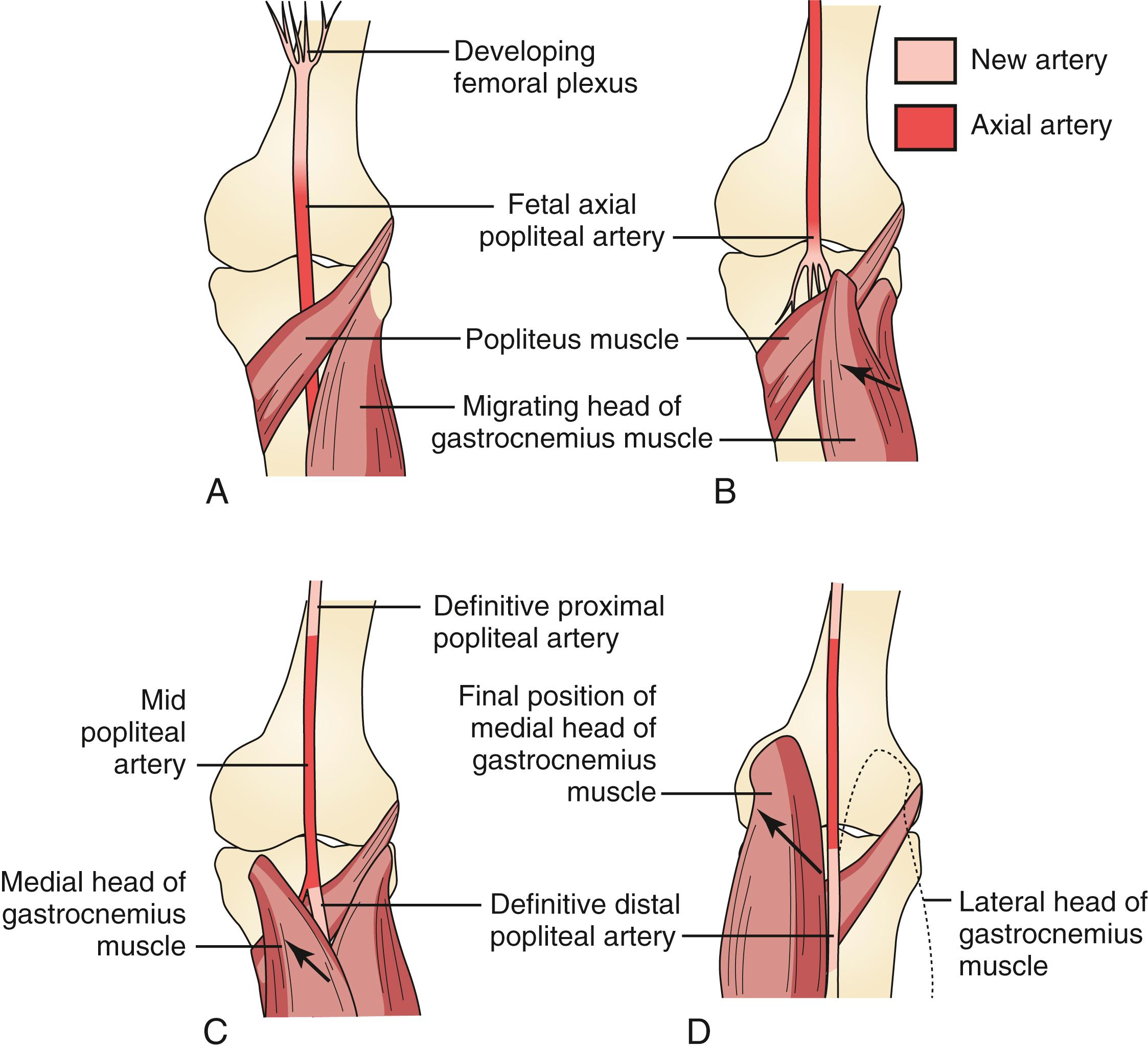 Figure 144.2, Migration of the medial head of the gastrocnemius muscle through the popliteal fossa during formation of the popliteal artery. ( A ) The medial head of the gastrocnemius muscle begins to migrate from the region of the fibula. At this stage, the axial distal popliteal artery lies deep to the popliteus muscle. ( B ) The distal portion of the popliteal artery involutes as the medial head of the gastrocnemius muscle passes from lateral to medial. The proximal popliteal artery is derived from fusion with the developing femoral plexus, whereas the midportion of the popliteal artery is formed from the persistent axial artery remnant. ( C ) A new or nonaxial distal popliteal artery now forms superficial to the popliteus muscle, after the medial head has migrated through the popliteal fossa. ( D ) Normal definitive popliteal anatomy.