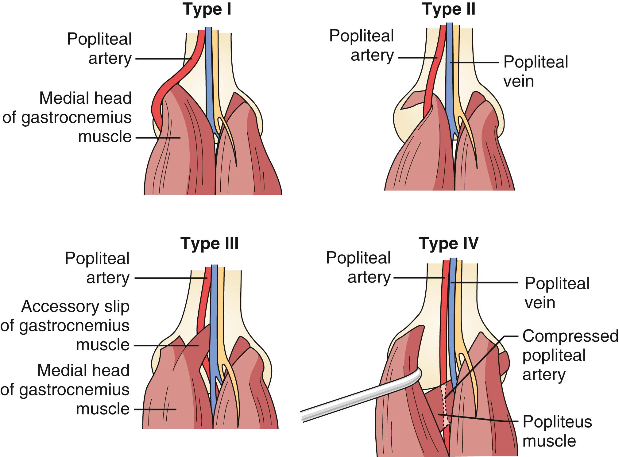 Figure 144.3, Types of popliteal artery entrapment syndromes.