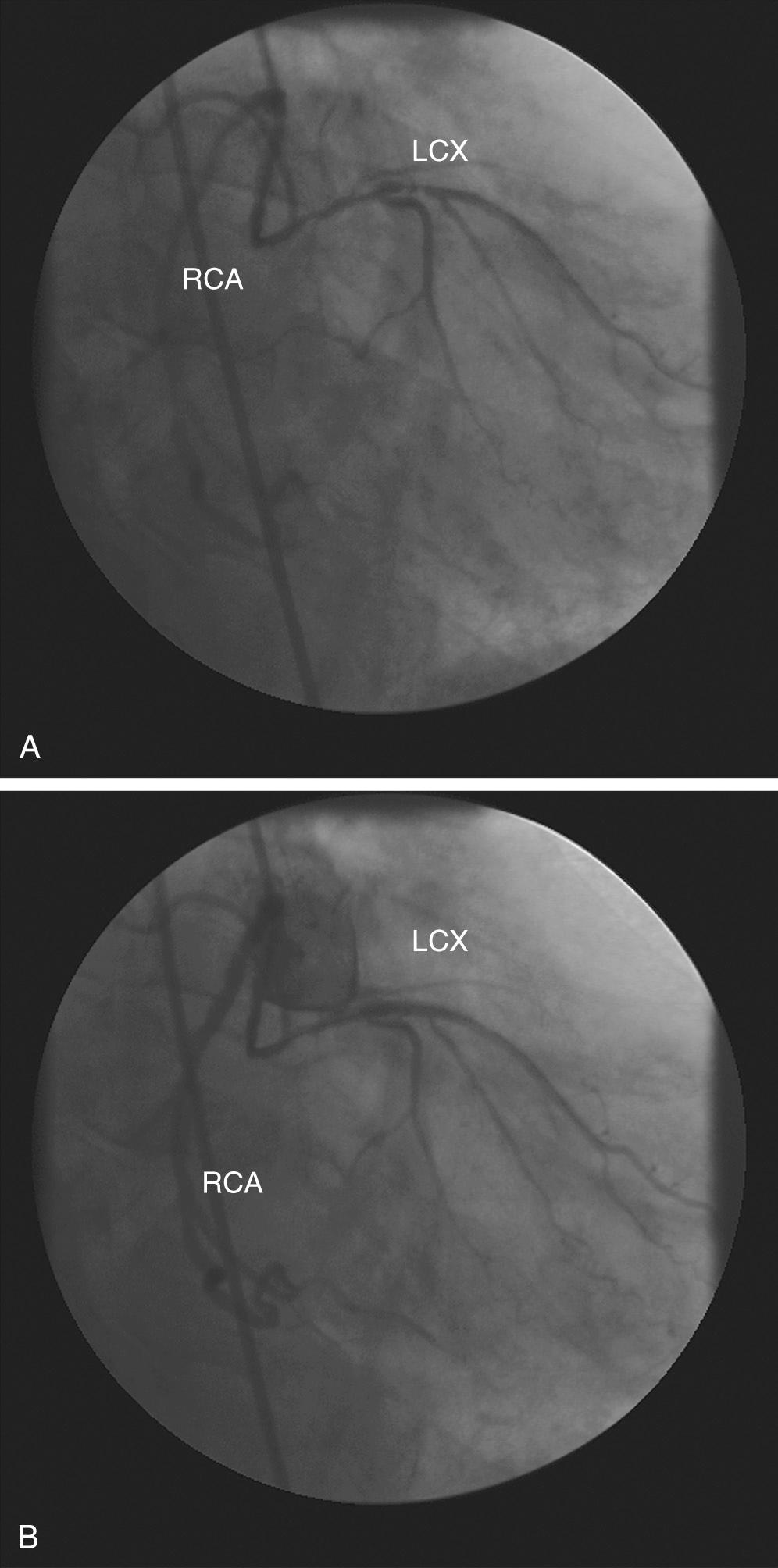 FIGURE 94-1, Anomalous origin of the left circumflex (LCX) from the right coronary artery (RCA) in (A) the shallow right anterior oblique, and (B) the right anterior oblique projections.