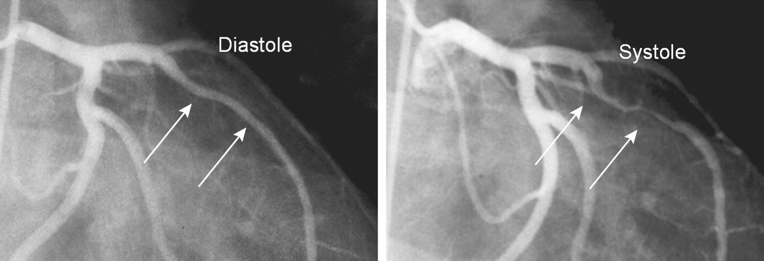 FIGURE 94-4, Muscle bridge (arrows) causing compression during systole.