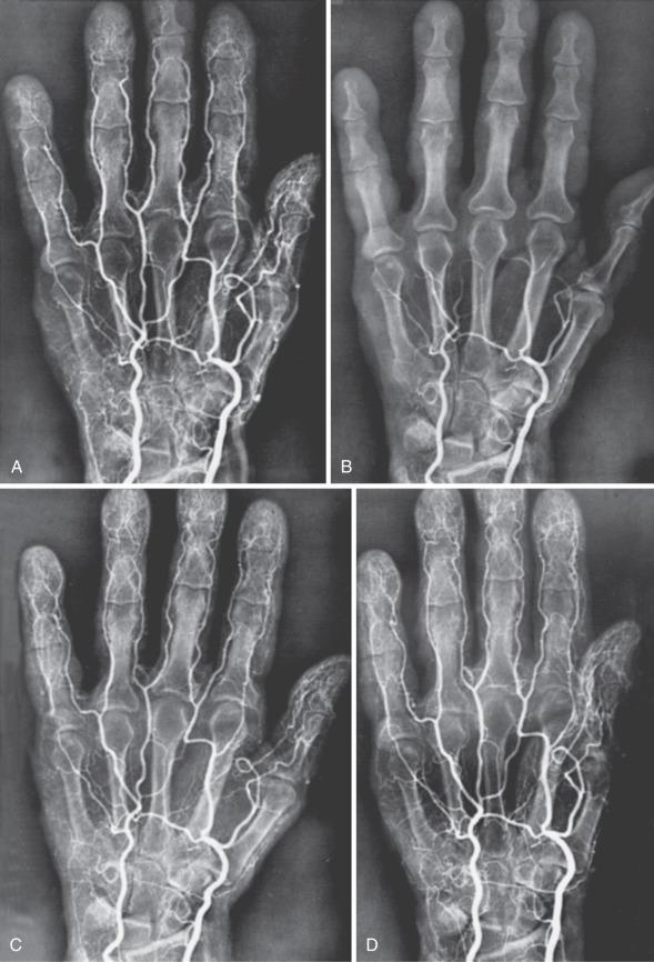 FIG 8.1, Hand angiograms of a Raynaud syndrome patient before and after cold exposure and before and after administration of intraarterial reserpine. A marked vasospastic response to cold exposure, which is blocked by reserpine administration, is demonstrated. (A) Before cold, before reserpine. (B) After cold, before reserpine. (C) Before cold, after reserpine. (D) After cold, after reserpine.
