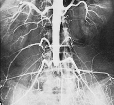 FIG 8.4, Radiation Arteritis.