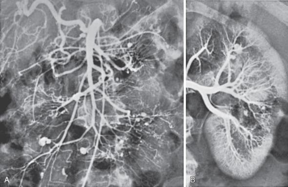 FIG 8.5, (A) Arteriogram showing multiple visceral aneurysms in a patient with polyarteritis nodosa. (B) Multiple renal artery aneurysms in the same patient.