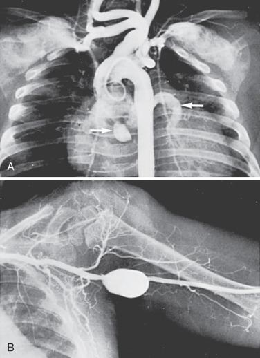 FIG 8.6, (A) Arteriogram of an infant with Kawasaki disease showing coronary artery aneurysms (white arrows) and massive subclavian artery aneurysms. (B) Arteriogram of a 2-year-old child showing a large axillary artery aneurysm resulting from Kawasaki disease.