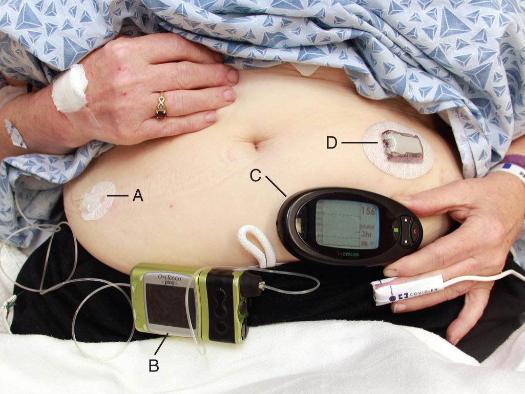 Figure 70.1, External insulin infusion pump. Components include a subcutaneously implanted catheter (A) and a programmable infusion pump (B) (OneTouch Ping, Animas Corporation, West Chester, PA). To discontinue the flow of insulin into the patient, simply peel off the adhesive and embedded catheter together. Also shown is a wireless continuous glucose monitoring receiver (C), along with its sensor and transmitter (D) (exCom SEVEN PLUS, DexCom, Inc., San Diego, CA).