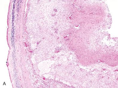 Fig. 7.2, Pilocytic astrocytomas. These histologically benign tumors are associated with a wide morphologic spectrum. (A) In classic examples such as this one, the tumor appears sharply demarcated from the adjacent atrophic cerebellar cortex (left). The loose microcystic component is in the middle and the dense element is on the right. Nonetheless, most examples show at least focal invasion into adjacent brain parenchyma. (B) Cytologic smear preparations demonstrate long thin “hair-like” or piloid processes. (C) This area shows a biphasic appearance with intermixed dense and loose foci. (D) The loose component may resemble an oligodendroglioma, although thin GFAP-positive processes are typically seen on immunohistochemistry (see Fig. 7.3B ). (E) Densely fibrillar regions with abundant Rosenthal fibers (RFs) are seen in some pilocytic astrocytomas such as this one, whereas RFs are rare to absent in others. In the absence of a loose component, “piloid gliosis” should be excluded. (F) Abundant eosinophilic granular bodies (EGBs) are more often encountered in the loose regions. (G) Multinucleated cells often show a horseshoe or “pennies on a plate” (as if a stack of pennies was splayed out peripherally on a plate) arrangement (arrow). The cytologic atypia has no prognostic bearing and is likely degenerative in nature. (H). Extension into the subarachnoid space is common (note edge of two adjacent cerebellar folia in right upper and lower regions). (I) Microvascular hyperplasia is typical, especially in regions of the cyst lining. In this example, the vessels are mostly glomeruloid with multiple lumens and a single cell lining. However, the endothelia also appear hypertrophic and multilayered focally, as one might see in glioblastomas. In the setting of pilocytic astrocytoma, this finding has no ominous implications. (J) Some pilocytic astrocytomas have tortuous and variably dilated vasculature with marked hyalinization, potentially mimicking cavernous angioma. (K [H&E], L [GFAP]) When pilocytic astrocytomas grow through the subarachnoid space to bridge two cerebellar folia, they often create GFAP-positive bundled processes that resemble “bales of hay.”