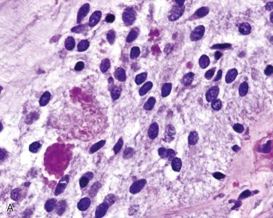 Fig. 7.3, Special studies and “atypical features” in pilocytic astrocytomas. (A) A PAS with diastase stain is often useful for highlighting rare EGBs when they are difficult to see on routine H & E sections. (B) In contrast to most diffuse gliomas, pilocytic astrocytomas are often strongly and uniformly GFAP positive and this stain highlights their long, thin processes. (C) Occasional pilocytic astrocytomas have a more diffusely infiltrative growth pattern as evidenced by the many entrapped neurofilament positive axons in this example. The prognosis for such cases is no different from that of conventional counterparts when other classic features are present. (D–F) Increased mitotic figures (but <5/10 HPF) (D; arrow ) and/or Ki-67 labeling (E) is often worrisome, but similarly has little clinical impact if the case is otherwise classic for pilocytic astrocytoma. An additional stain for CD68 may be helpful in such cases, as it may reveal a surprising number of intratumoral macrophages or activated microglia (F), either of which can undergo cell division and artificially elevate the proliferative index. (G) The presence of infarct-like necrosis is seen in a small subset of pilocytic astrocytomas, but should not be interpreted as a malignant feature in the absence of associated palisading and other worrisome features, such as hypercellularity and brisk mitotic activity. (H) Some pilocytic astrocytomas display perivascular pseudorosettes focally. This finding is similar to pilomyxoid astrocytomas (see Fig. 7.4 ), but its potential significance is unclear in cases that display classic features of pilocytic astrocytoma elsewhere. (I, J) Most pilocytic astrocytomas strongly express the transcription factors, OLIG2 (I) and SOX10 (J). (K) A common genetic change detectable by FISH is the KIAA1549-BRAF fusion and duplication. In this example, there is an extra copy number (i.e., 3 total) of both green KIAA1549 and red BRAF signals, including a yellow fusion signal in most tumor nuclei.