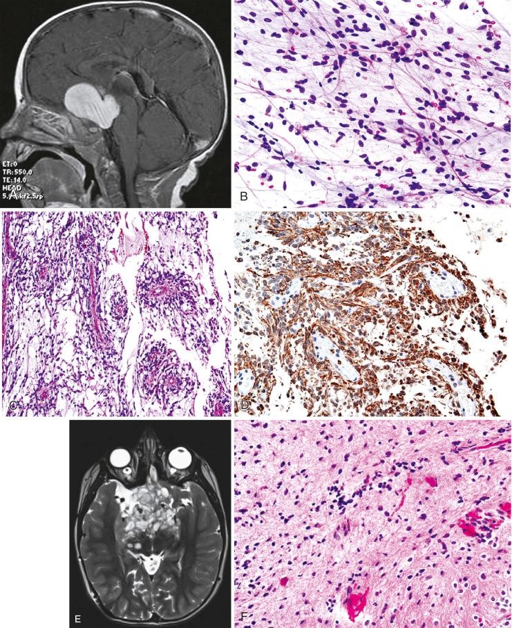 Fig. 7.4, Pilomyxoid astrocytomas (PMA). Despite a cytologically bland histology, these tumors of infancy may be more aggressive. (A) Postcontrast MRI demonstrating a large, relatively solid contrast-enhancing mass involving the optic chiasm and the hypothalamic region. (B) On smear preparations, nuclear uniformity and thin piloid processes are evident, essentially being indistinguishable from conventional pilocytic astrocytoma (compare with Fig. 7.2B ). (C) On sections, tumors are composed of monomorphic bipolar, highly fibrillar cells with an angiocentric pattern resembling perivascular pseudorosettes and a loose myxoid background. They lack the dense component, RFs, and EGBs of conventional pilocytic astrocytoma. (D) A GFAP stain highlights the piloid cytoplasmic processes, some of which appear to radiate toward central blood vessels. (E, F) This patient had a classic PMA during infancy and presented with a recurrence that appeared highly infiltrative on T2-weighted MRI several years later (E). Despite this alarming appearance on neuroimaging, the biopsy showed decreased cellularity with features of conventional pilocytic astrocytoma, including a more dense or compact component and scattered RFs (F). Some have termed this phenomenon as “maturation,” although its clinical significance remains unclear.