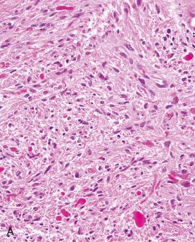 Fig. 7.5, Pilocytic astrocytoma with anaplastic features. The conventional low-grade component is illustrated in (A), while anaplastic foci included a high mitotic index (B) and palisading necrosis (C).