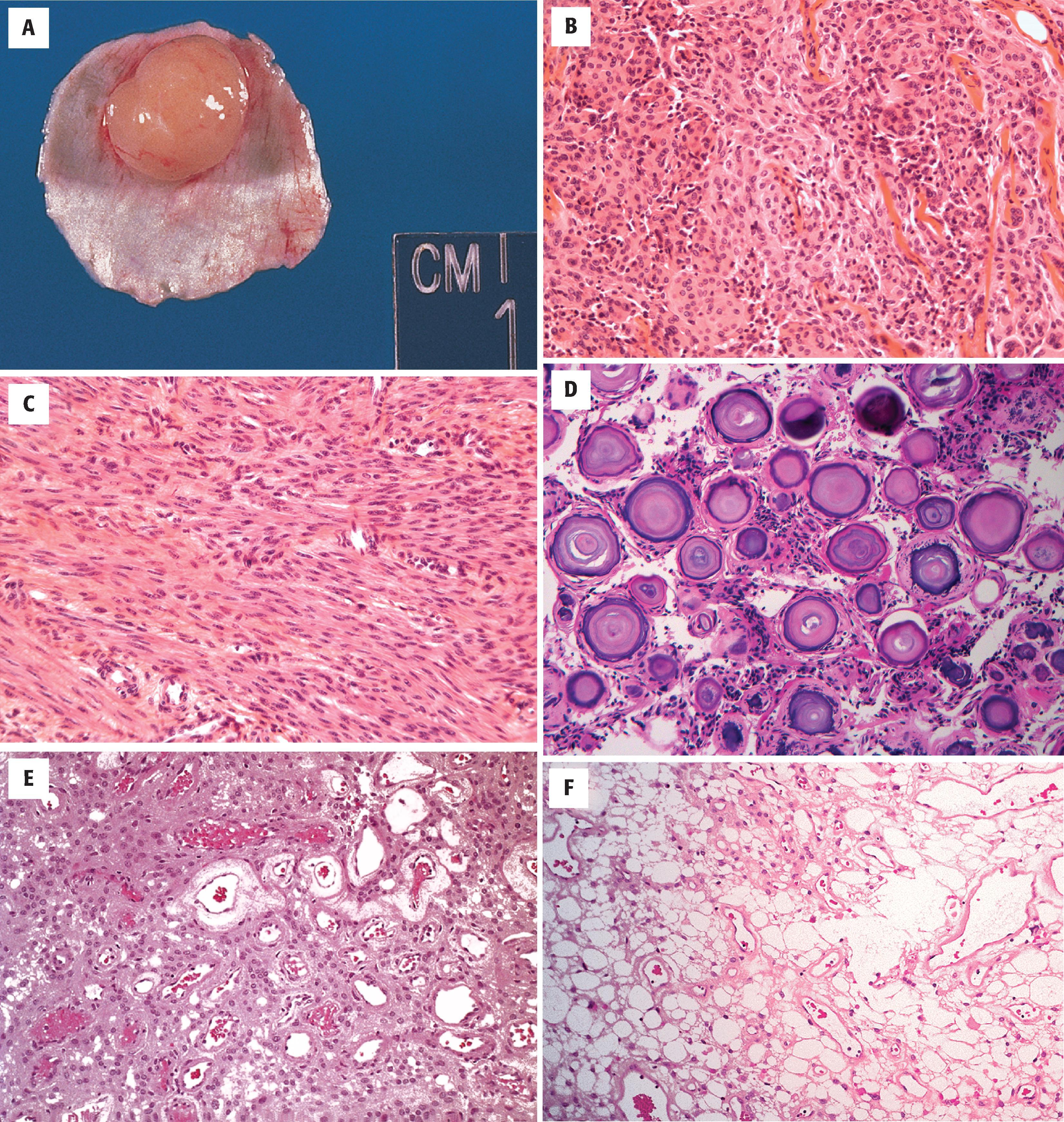 FIGURE 10.1, A, Gross appearance of a typical meningioma showing a well-circumscribed, tan-yellow mass attached to the dura. B, Meningothelial meningioma (WHO grade 1) marked by lobules of cells separated by fibrovascular septa. Whorling of cells in the lobules is common. C, Fibrous meningioma (WHO grade 1) characterized by a proliferation of monomorphic spindled cells. D, Numerous laminated calcified structures mark a psammomatous meningioma (WHO grade 1). E, Angiomatous meningioma (WHO grade 1) showing prominent numbers of blood vessels. F, Microcystic meningioma characterized by a loose cystic background (WHO grade 1).FIGURE 10.1, cont’dG, Secretory meningioma (WHO grade 1) characterized by the presence of intracellular eosinophilic lumina (so-called pseudopsammoma bodies). H, Metaplastic meningioma (WHO grade 1) marked by the presence of bone formation—osseous differentiation. I, Lymphoplasmacyte-rich meningioma (WHO grade 1) marked by lymphoid aggregates and increased lymphocytes and plasma cells.