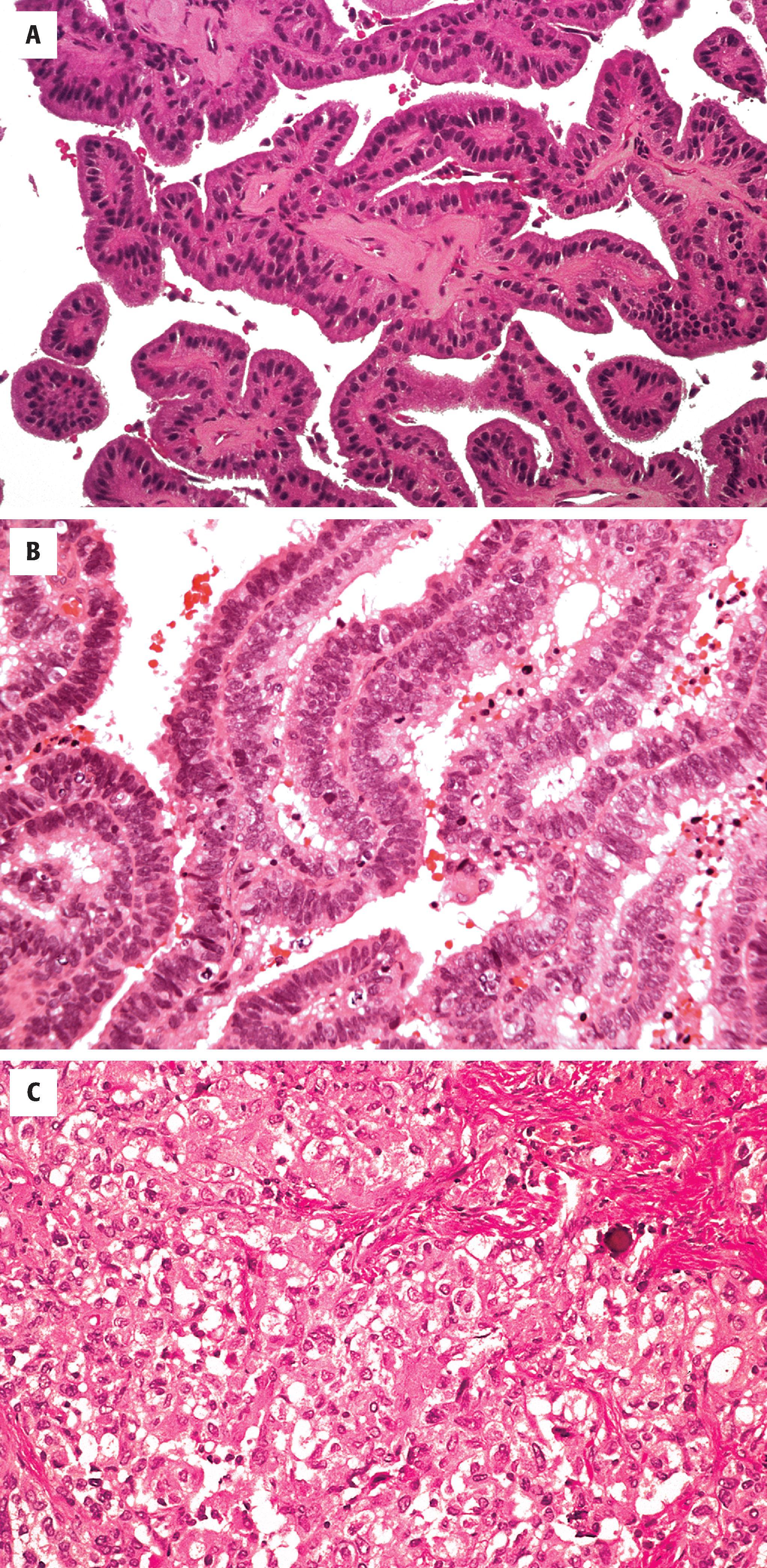 FIGURE 10.11, A, Choroid plexus papilloma marked by hyperplasia of bland choroid plexus epithelial cells on fibrovascular stalks. B, Atypical choroid plexus papilloma with mitoses and mild atypia. C, Choroid plexus carcinoma characterized by a sheet-like proliferation of atypical cells resembling carcinoma.