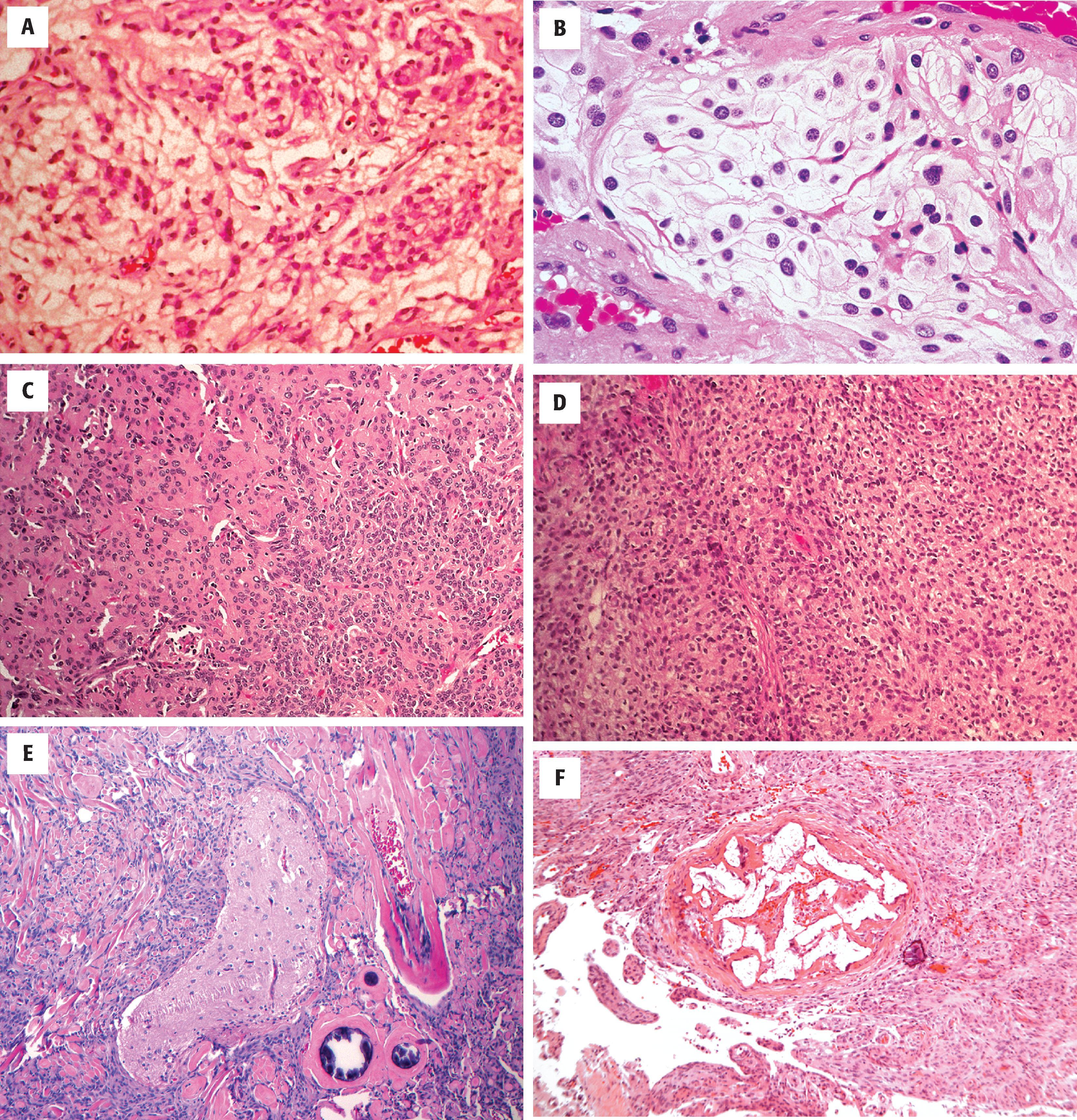 FIGURE 10.2, A, Chordoid meningioma (WHO grade 2) marked by the arrangement of meningothelial cells in the cords and trabeculae against a chondromyxoid background, reminiscent of a chordoma. B, Clear cell meningioma (WHO grade 2) composed of polygonal cells with abundant clear, glycogen-rich cytoplasm. C, Atypical meningioma (WHO grade 2) demonstrating small cell change with a disordered architectural pattern. D, Atypical meningioma marked by a disordered architectural pattern associated with increased mitotic activity, increased cellularity, and prominent nucleoli. E, Brain invasive meningioma (WHO grade 2) demonstrating parenchymal infiltration by tumor. F, Intratumoral blood vessel with evidence of preoperative embolization to reduce bleeding during surgery.