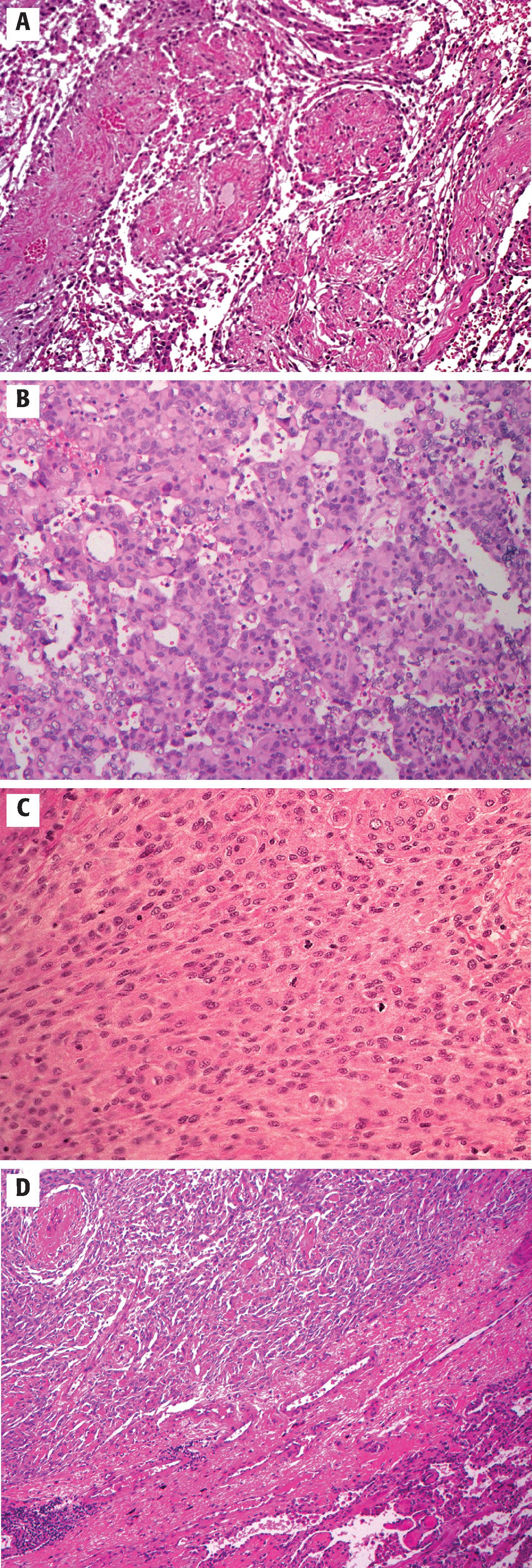 FIGURE 10.3, A, Papillary meningioma (WHO grade 3) marked by a pseudopapillary architectural pattern with meningothelial cells arranged around vascular or fibrovascular cores. B, Rhabdoid meningioma (WHO grade 3) characterized by the presence of large cells with eccentric nuclei and prominent eosinophilic cytoplasmic inclusions resembling cells seen in rhabdoid tumors. C, Anaplastic malignant meningioma (WHO grade 3) characterized by extremely high mitotic activity and malignant cytology. D, Anaplastic meningioma (WHO grade 3) that metastasized to the lung.