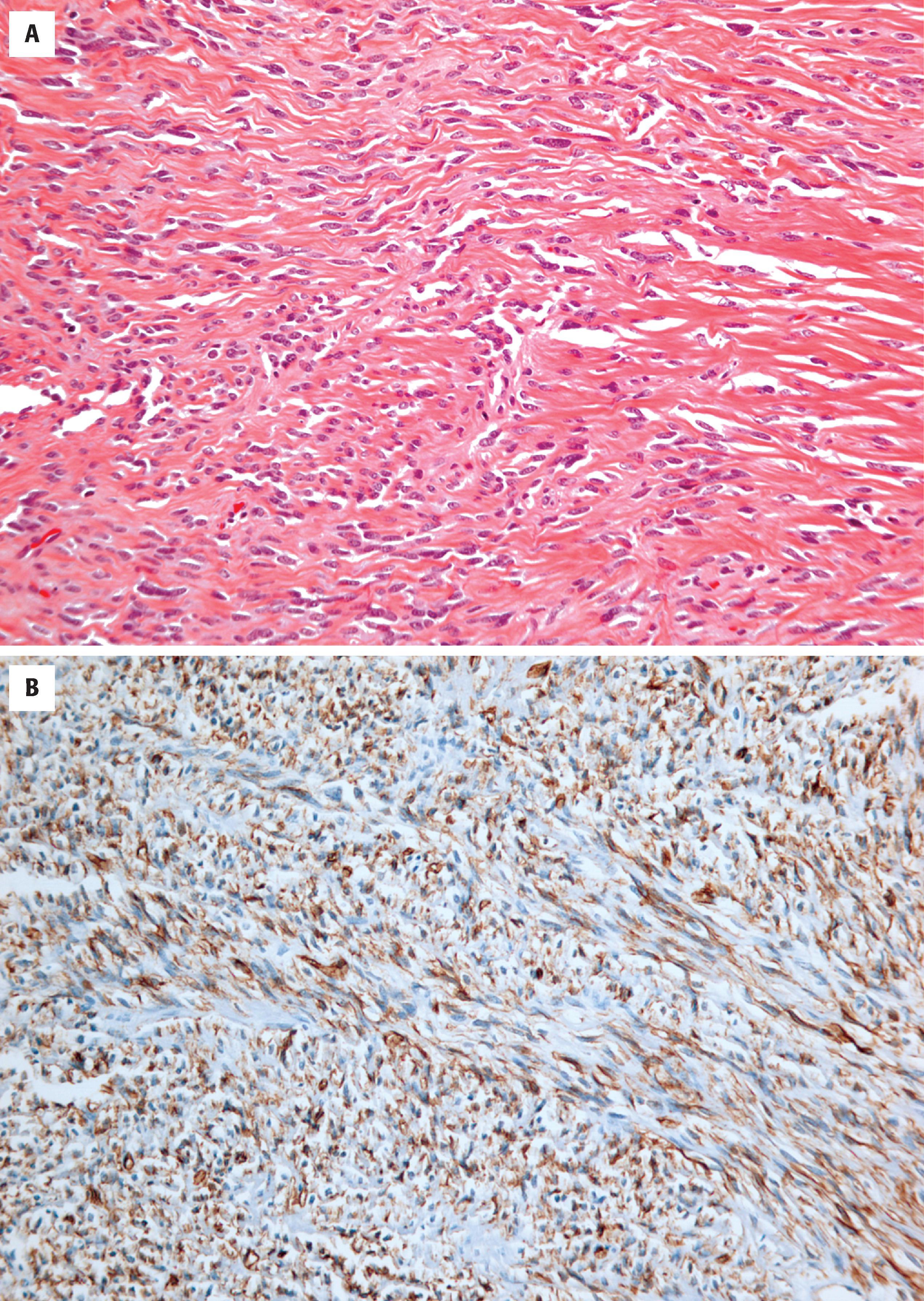 FIGURE 10.4, A, Low-grade solitary fibrous tumor (WHO grade 1) may resemble a fibrous meningioma. In contrast to fibrous meningioma, solitary fibrous tumors are marked by abundant collagen material deposited between individual cells. B, CD34 immunoreactivity in a low-grade solitary fibrous tumor.