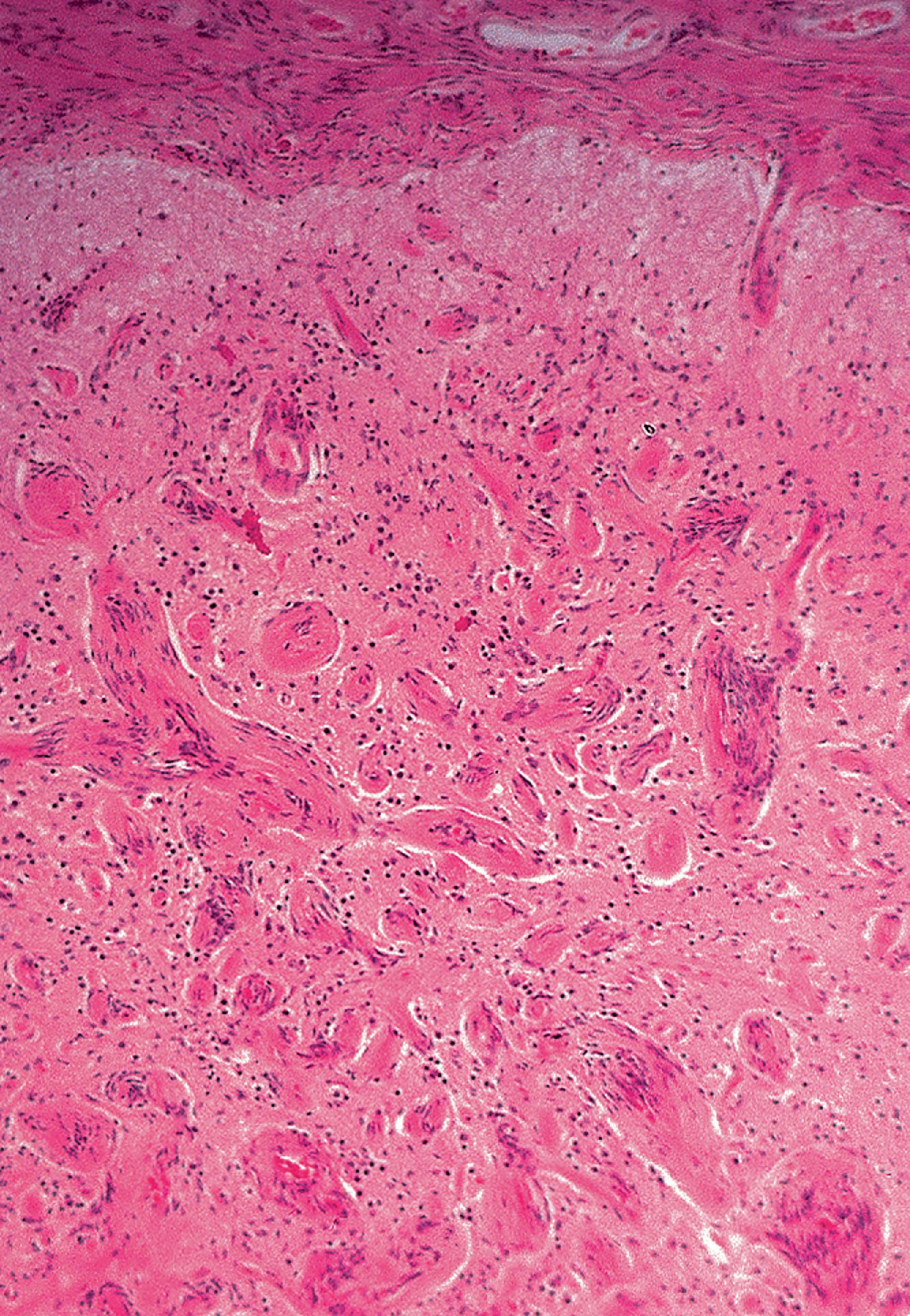 FIGURE 10.5, Meningioangiomatosis is characterized by a proliferation of meningothelial cells and vessels. Collars of meningothelial cells surround parenchymal vessels.