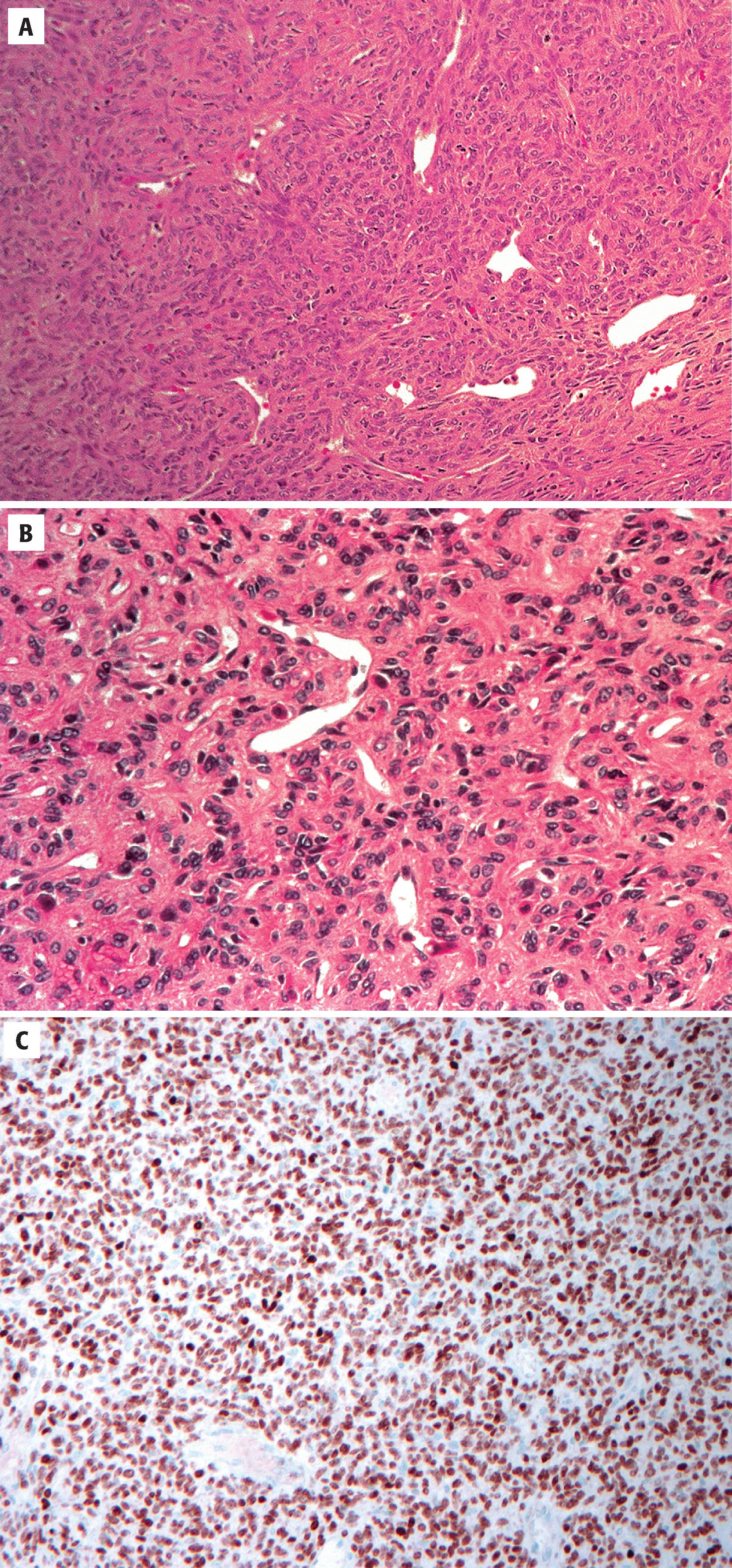 FIGURE 10.6, A, High-grade solitary fibrous tumor with marked hypercellularity and a staghorn vascular pattern. B, Nuclear atypia and a vascular pattern typical of high-grade solitary fibrous tumor/hemangiopericytoma. C, STAT6 immunostaining in a high-grade solitary fibrous tumor.