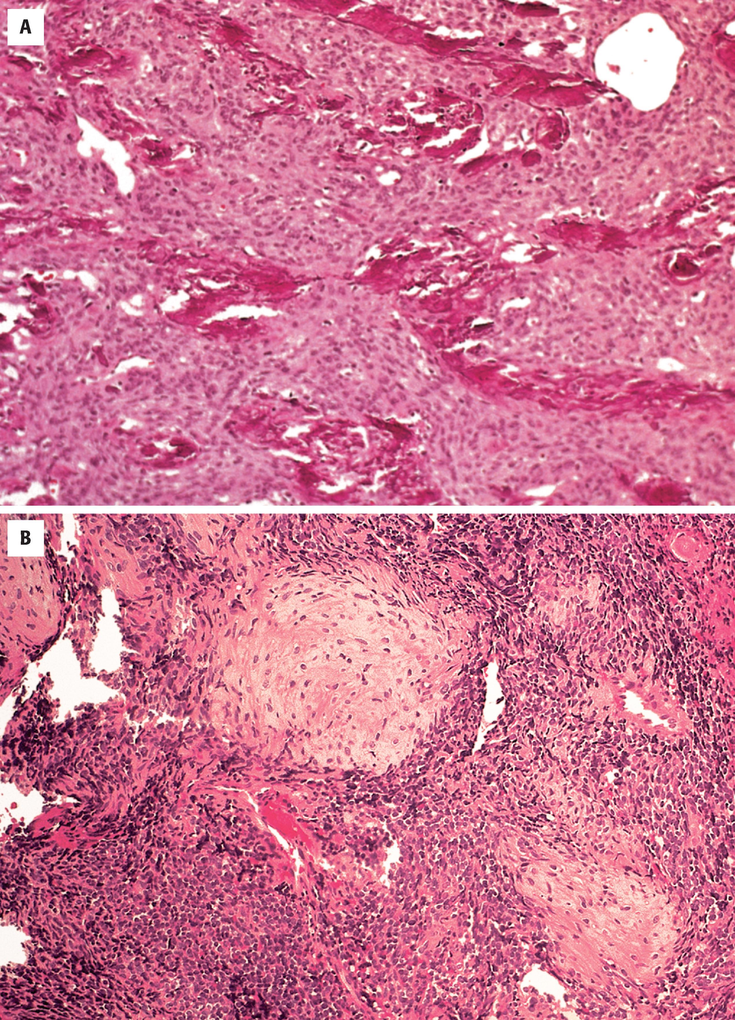 FIGURE 10.7, A, Abundant bone formation for the diagnosis of osteosarcoma. B, Focal chondroid differentiation in the background of otherwise undifferentiated tumor characterizes mesenchymal chondrosarcoma.