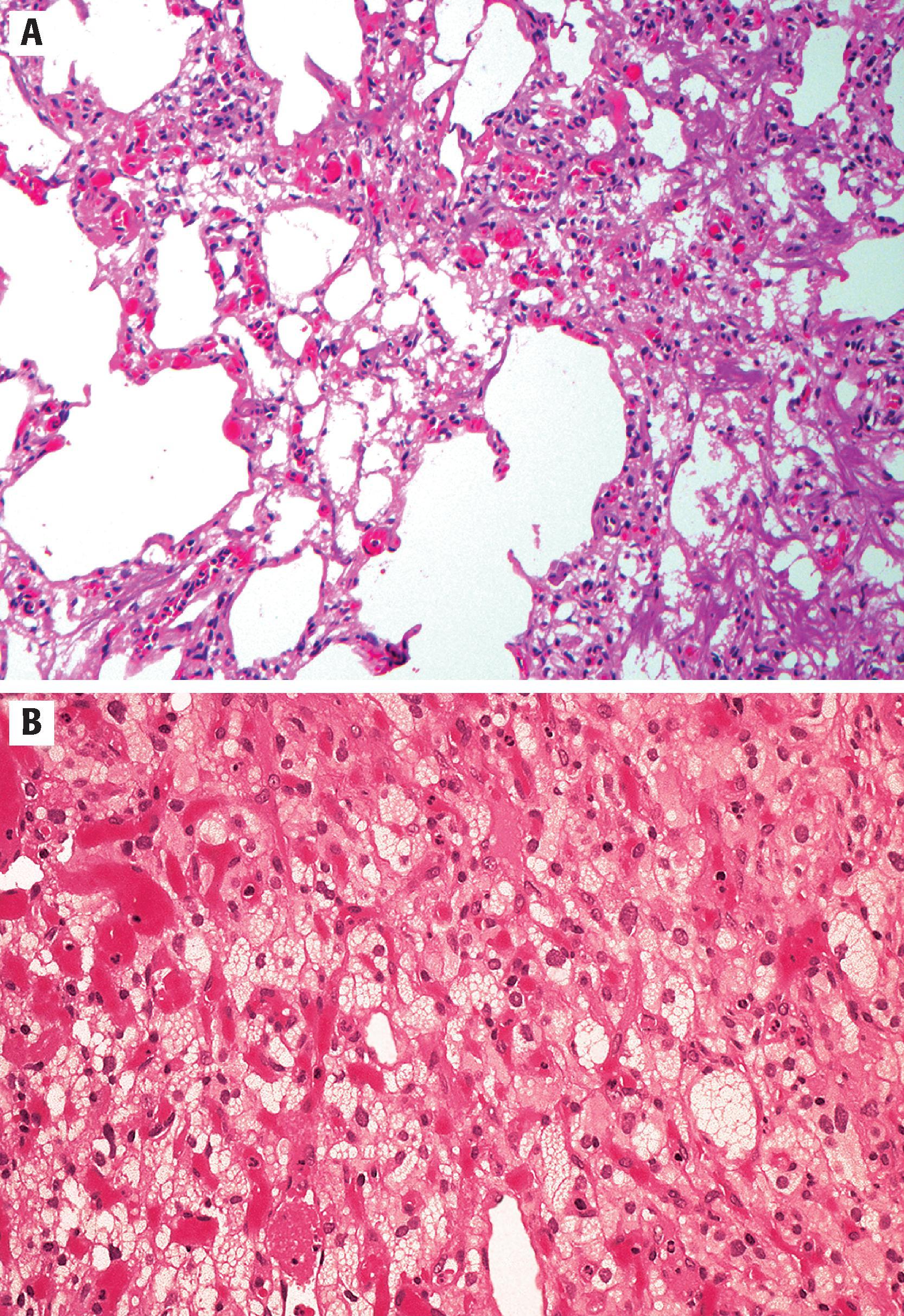 FIGURE 10.8, A, Large cystic pools with abundant vessels mark this hemangioblastoma. B, Hemangioblastoma characterized by the presence of abundant small vessels and stromal cells with clear, vacuolated cytoplasm.