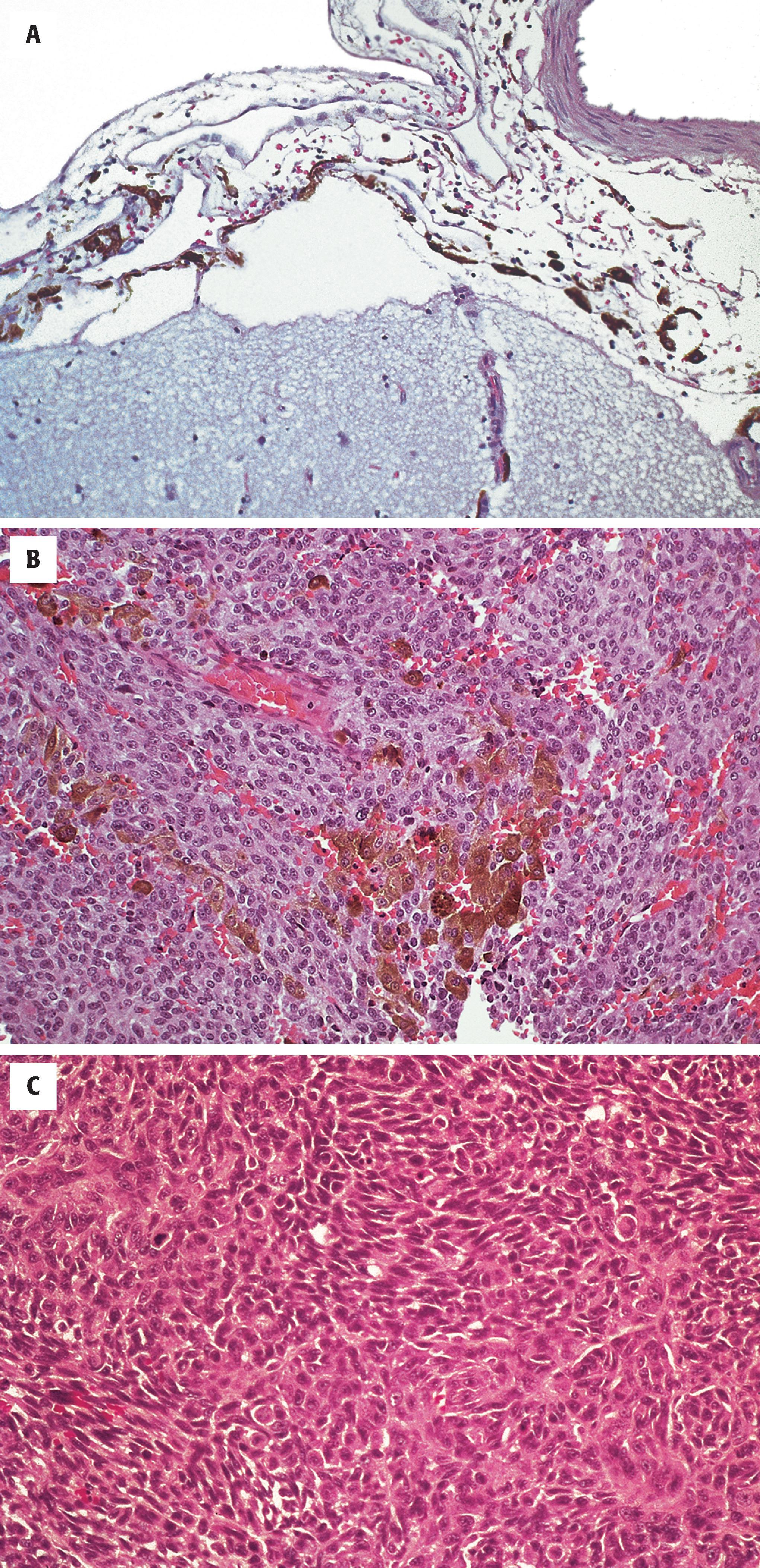 FIGURE 10.9, A, Proliferation of nevoid cells in the leptomeninges marks melanocytosis. B, Melanocytoma characterized by a proliferation of monomorphic-appearing cells and abundant melanin deposition. C, Markedly hypercellular malignant melanoma with prominent nuclear atypia and mitotic figures.