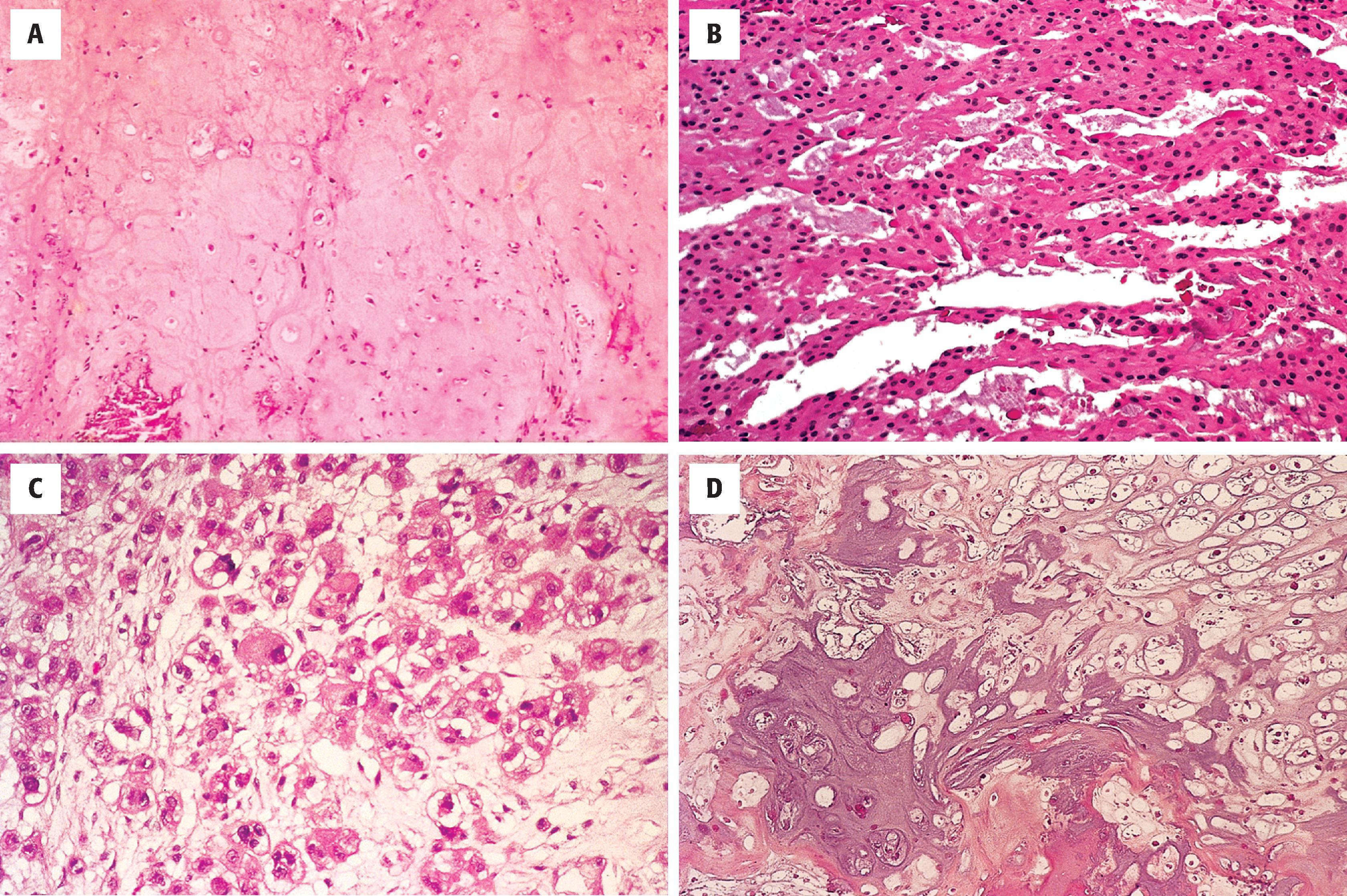 FIGURE 10.10, A, An area of chondroid differentiation in a chondroid chordoma. B, Cords and nests of epithelioid cells in a chordoma. C, Epithelioid cells with markedly vacuolated cytoplasm, so-called physaliphorous cells. D, Chondrosarcoma marked by atypical nuclei, in contrast to the bland nuclei of chondroid chordoma.