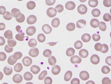 Figure 58-1, Normocytic anemia with schistocytes due to metastatic lung carcinoma.