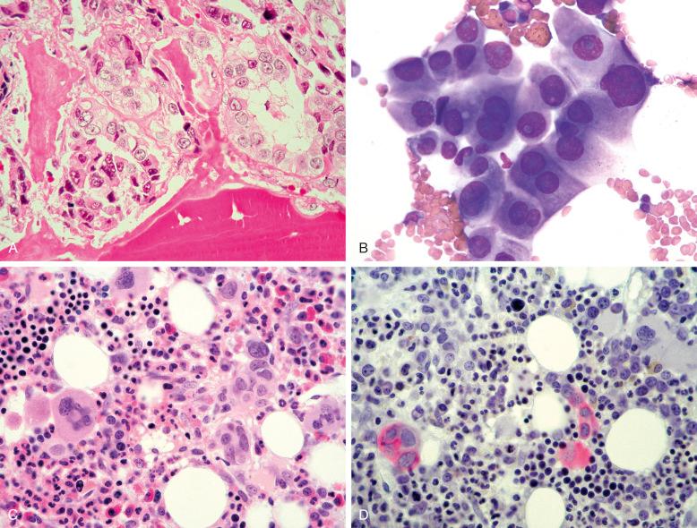 Figure 58-2, Metastatic adenocarcinoma of the breast in a bone marrow biopsy (A) and a bone marrow aspirate smear (B). C, Another bone marrow biopsy shows inconspicuous involvement by metastatic breast carcinoma. D, The same biopsy shows the tumor cells highlighted by a pan-keratin stain.