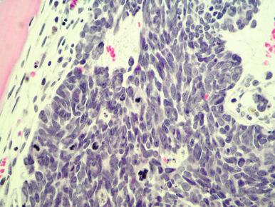 Figure 58-3, Small-cell carcinoma of the lung metastatic to the bone marrow.